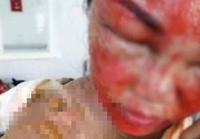 Điều tra vụ chồng nhẫn tâm hất cả ấm nước sôi lên đầu khiến vợ bỏng nặng