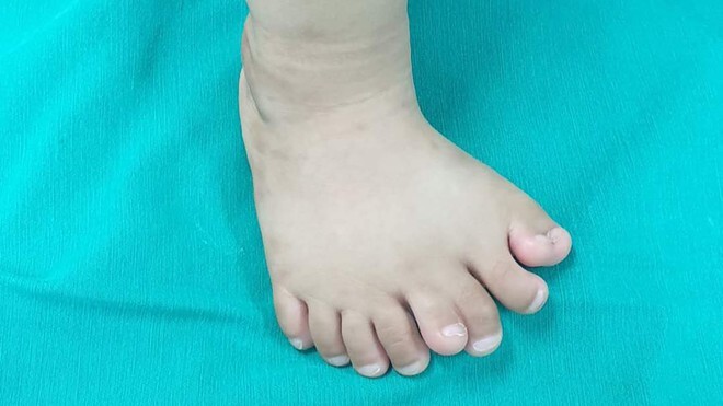 Kỳ lạ bé trai 11 tháng tuổi có tới 9 ngón chân, dị tật hiếm gặp khiến gia đình hoang mang