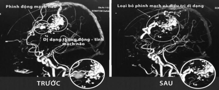 Cẩn trọng với những cơn đau đầu dữ dội của người trẻ