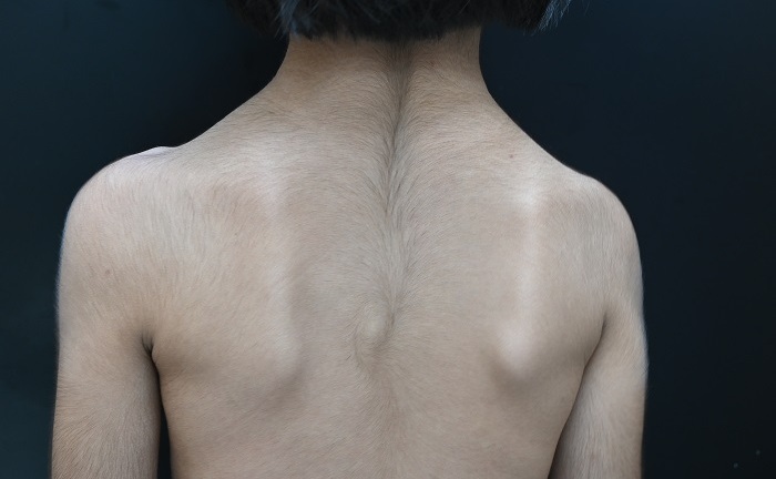 Bé gái 6 tuổi mắc bệnh kỳ lạ, lần đầu tiên xuất hiện ở Việt Nam