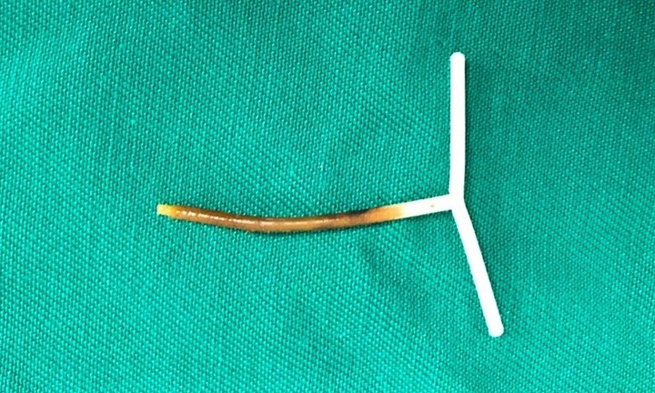 Tin tức đời sống mới nhất ngày 26/7/2020: Vòng tránh thai đâm thủng đại tràng