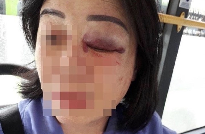 Nhắc khách vặn nhỏ nhạc, nữ nhân viên xe buýt bị đánh bầm mắt