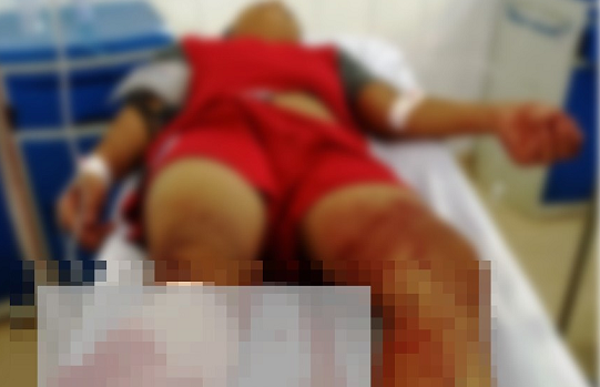 Vụ thiếu niên 15 tuổi bị chém lìa chân: Người mẹ tiết lộ 