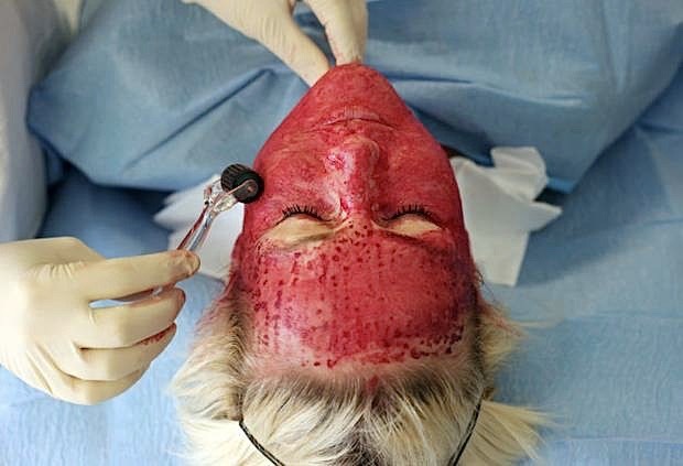 Rủi ro khôn lường từ phương pháp làm đẹp cấy máu tự thân