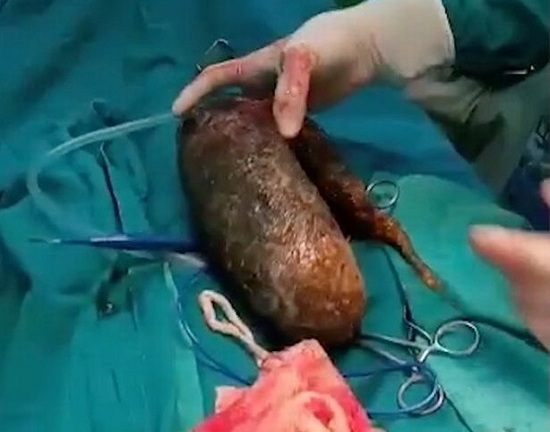 Hãi hùng cảnh bác sĩ lôi búi tóc nặng 7kg ra khỏi bụng thiếu nữ 17 tuổi