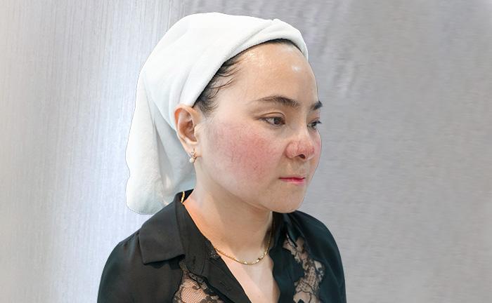 Dấu hiệu giãn mao mạch & cách điều trị tối ưu?