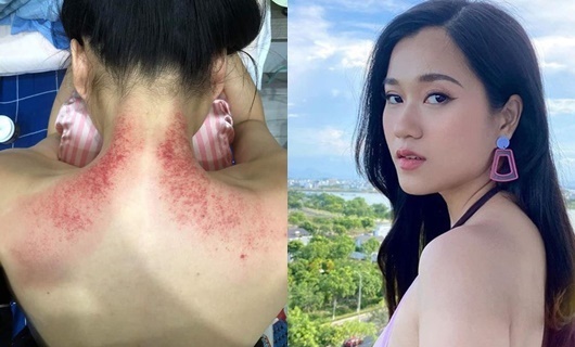 Tin tức giải trí mới nhất ngày 20/9/2020: Lâm Vỹ Dạ giải thích về tấm lưng trần chằng chịt vết đỏ