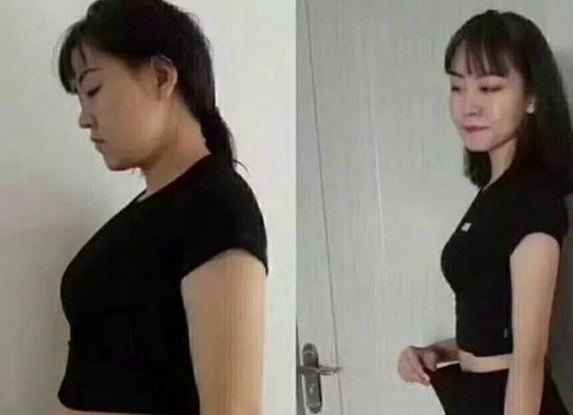 Giảm 10kg trong một tuần, cô gái đột ngột nhập viện vì mắc phải sai lầm này