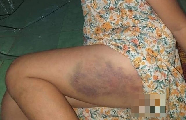 Vụ học sinh lớp 3 bị cô giáo đánh tím đùi: Vì