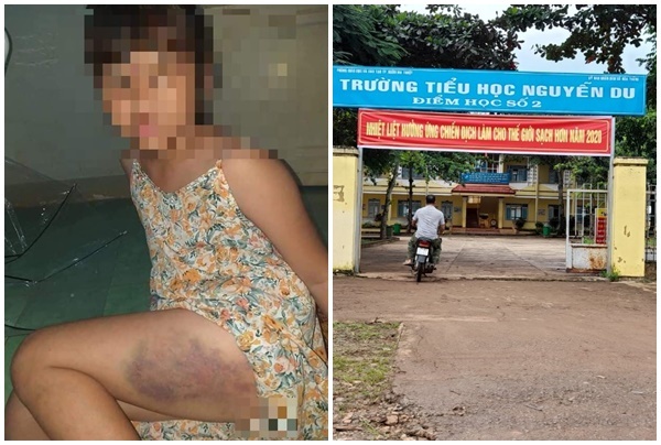 Vụ học sinh lớp 3 bị cô giáo đánh tím đùi ở Đắk Lắk: Gia đình nạn nhân nói gì?
