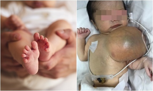 Tin tức đời sống mới nhất ngày 13/11: Cắt khối u khổng lồ cho bé 3 ngày tuổi