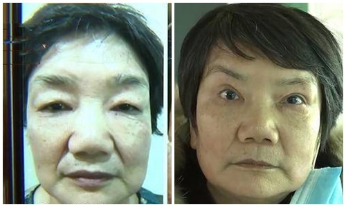 Chi gần 1 tỷ đồng để thẩm mỹ, vợ cay đắng vì mặt biến dạng còn bị chồng đuổi khỏi nhà