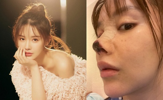 Sao nữ xinh đẹp phải đền tiền tỉ vì không thể đóng phim do mũi bị hoại tử sau phẫu thuật