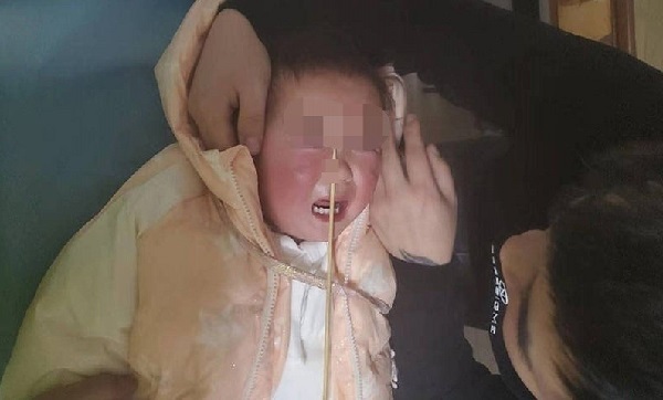 Bé 2 tuổi bị que tre đâm xuyên mũi khi đang ăn món quen thuộc, nguyên nhân cảnh tỉnh nhiều cha mẹ