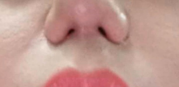 Tin tức đời sống ngày 28/2: Không thở được, mất khứu giác sau nâng mũi