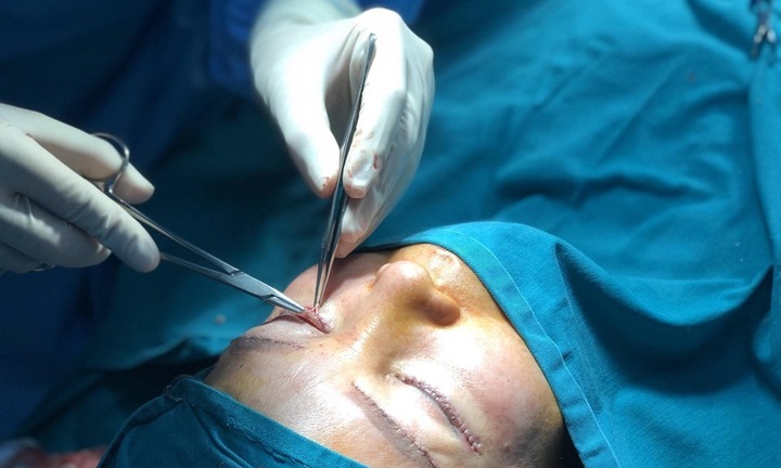 Hà Nội: Đi spa cắt mí, cô gái 23 tuổi bị mù 1 bên mắt