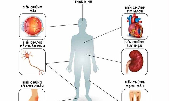 BoniDiabet – Bí quyết xua tan nỗi ám ảnh mang tên biến chứng tiểu đường