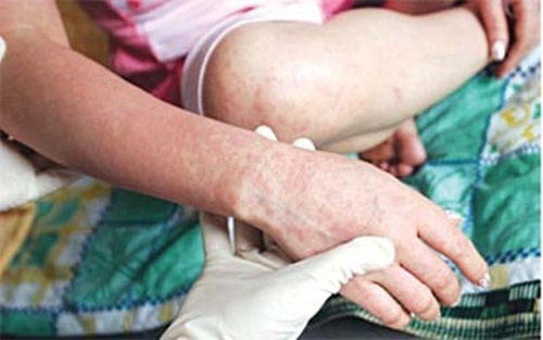 Biến chứng sởi: Người lớn có thể bị viêm màng não, tử vong