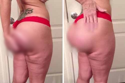 Video kinh hoàng về một trường hợp “độn” mông hỏng