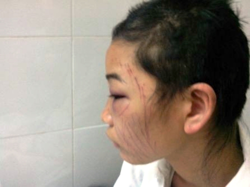 Xem xét khởi tố vụ án chồng ép vợ tự rạch mặt, cắt tóc