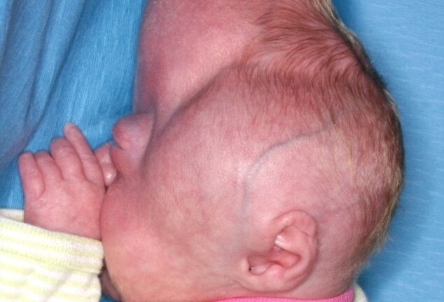 Mang căn bệnh quái ác, bé gái có đầu hình cỏ ba lá