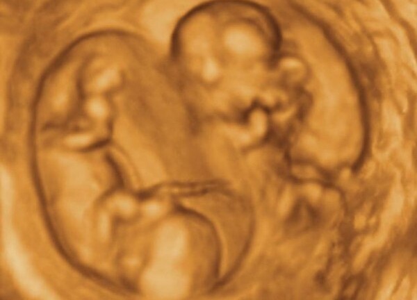 Kỳ lạ sản phụ sinh 10 con một lúc