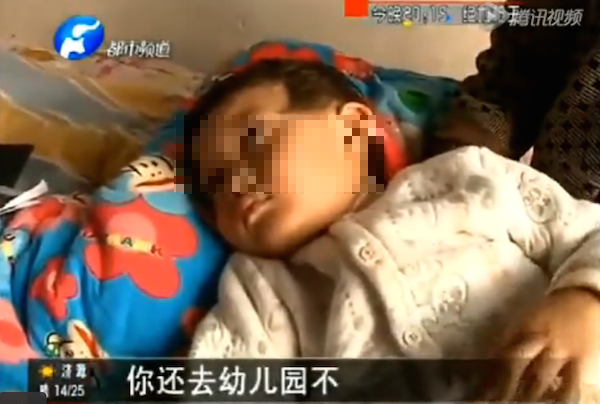 Bé 3 tuổi nhiễm trùng phổi nghi bị cô giáo châm kim khắp người