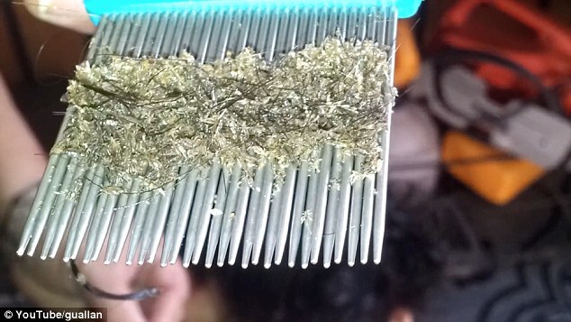 Kinh hãi những vụ ký sinh trùng “làm tổ” trên người