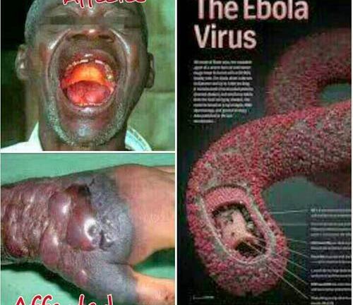Dịch Ebola: Triệu chứng đặc thù khi mắc bệnh Ebola