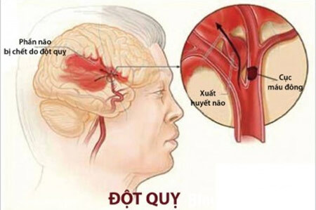 Đột quỵ - bệnh nguy hiểm chết người dễ mắc vào mùa đông