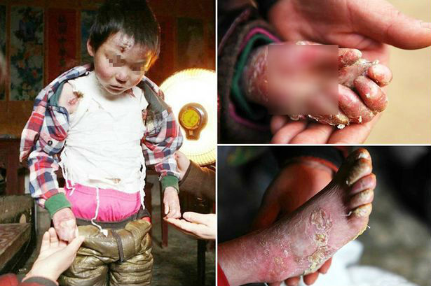 Bé trai 8 tuổi mắc bệnh lạ, da liên tục bong tróc