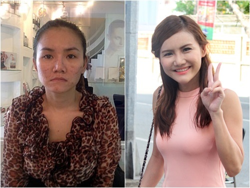 Anh Thúy X-factor ngày càng xinh đẹp sau phẫu thuật thẩm mỹ