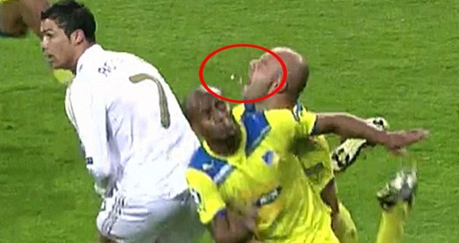 Tổng hợp những pha gãy răng của sao bóng đá trên sân cỏ