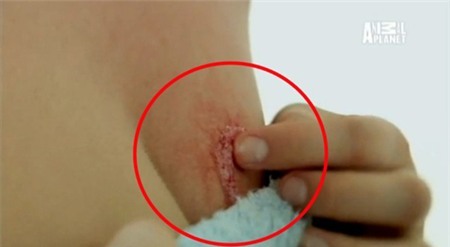 Kinh rợn giun móc bò lổm ngổm dưới da người