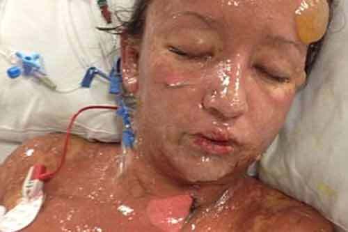 Cơ thể thiếu nữ bị bỏng rộp nặng do dị ứng với thuốc 