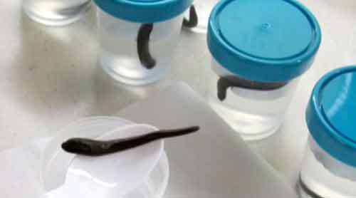 Dùng 1.400 con đỉa để... chữa lành bàn tay cho bệnh nhân