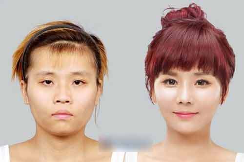 Phẫu thuật thẩm mỹ để nữ tính hơn vì quá nam tính