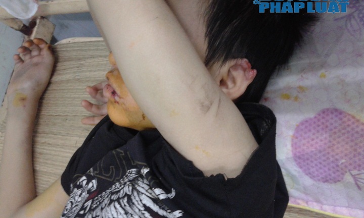 Bé trai 14 tuổi bị hành hung đã qua cơn nguy kịch