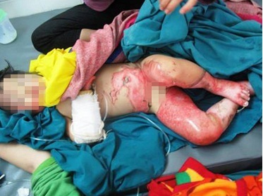 Rò rỉ đường ống dẫn ga, 2 mẹ con bị bỏng nặng