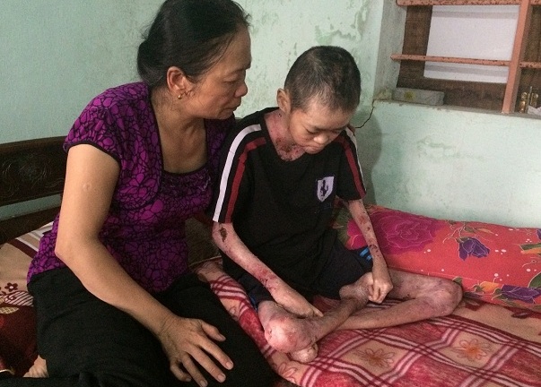 Mang căn bệnh quái ác, chàng trai 20 tuổi bong da, tróc thịt từng ngày