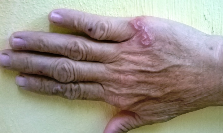 Phát hiện “sinh vật lạ” ngoe nguẩy dưới... mu bàn tay