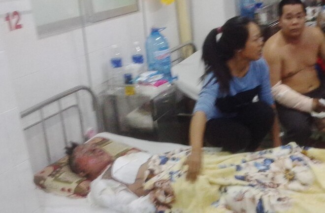 Đồng Nai: Bỏng nặng vì hút thuốc khi sửa xe