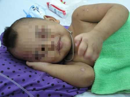 Bé trai 2 tuổi bị bà ngoại đánh: Sức khỏe dần bình phục