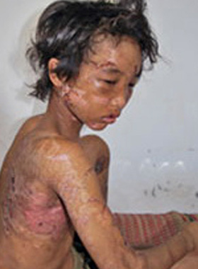 Nhìn lại hình ảnh xót xa cậu bé Hào Anh bị bạo hành