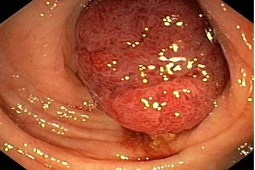 U đại tràng: Dễ tử vong vì khó phát hiện