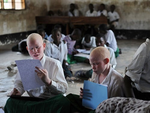 Tanzania: Người bạch tạng bị săn, lùng buôn bán để tìm vận may