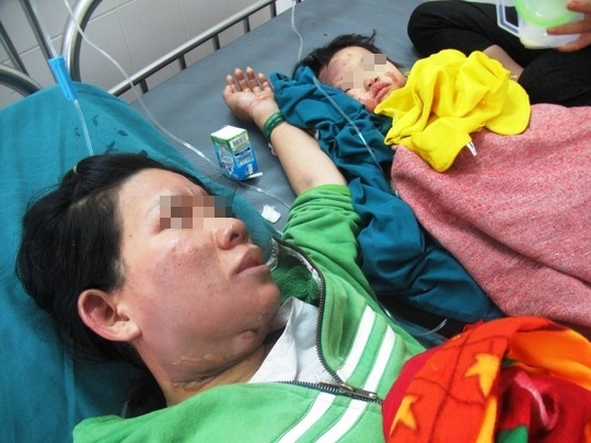 Thương tâm 2 mẹ con bị bỏng nặng khi nấu ăn cho bố
