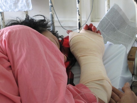 Chặt dừa, nam thanh niên bị đứt gần lìa bàn tay