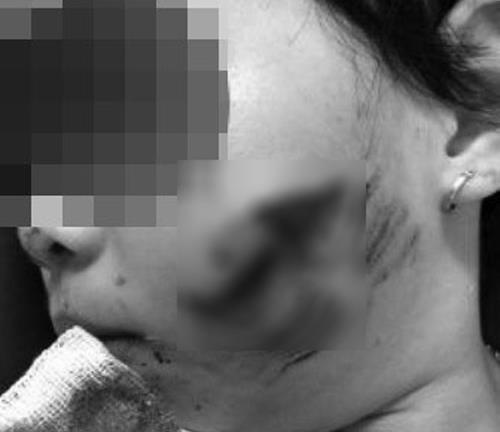 Thương tâm trẻ nhỏ bị chó nhà nổi điên cắn nát mặt