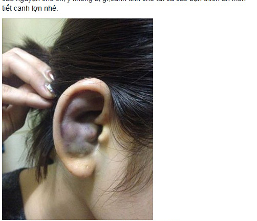 Sự thật về bức ảnh cô gái ăn tiết canh bị nghi nhiễm liên cầu lợn